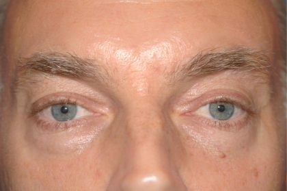 Eyelid Surgery - Blepharoplasty - Lower Eyelids Before & After Patient #5474