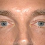 Eyelid Surgery - Blepharoplasty - Lower Eyelids Before & After Patient #5474