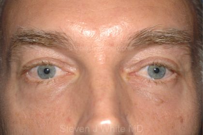 Eyelid Surgery - Blepharoplasty - Lower Eyelids Before & After Patient #5474