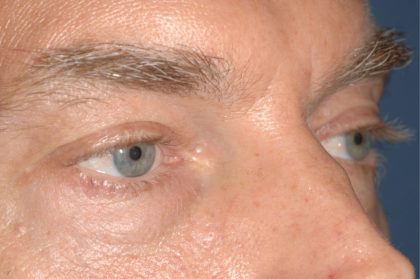 Eyelid Surgery - Blepharoplasty - Lower Eyelids Before & After Patient #5474