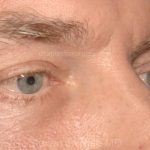 Eyelid Surgery - Blepharoplasty - Lower Eyelids Before & After Patient #5474