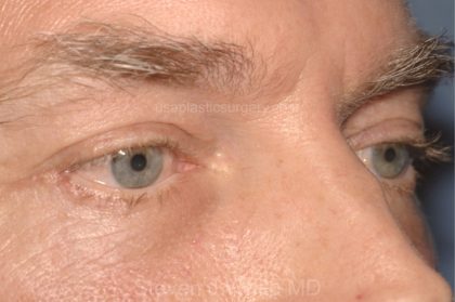 Eyelid Surgery - Blepharoplasty - Lower Eyelids Before & After Patient #5474