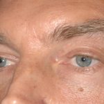 Eyelid Surgery - Blepharoplasty - Lower Eyelids Before & After Patient #5474