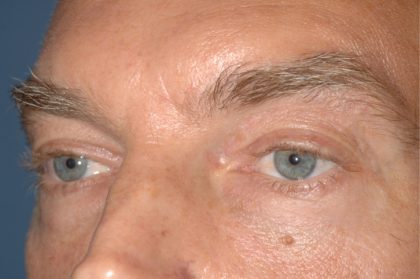 Eyelid Surgery - Blepharoplasty - Lower Eyelids Before & After Patient #5474