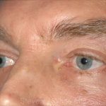 Eyelid Surgery - Blepharoplasty - Lower Eyelids Before & After Patient #5474