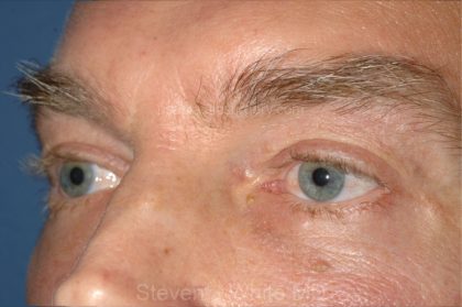 Eyelid Surgery - Blepharoplasty - Lower Eyelids Before & After Patient #5474