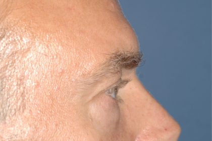 Eyelid Surgery - Blepharoplasty - Lower Eyelids Before & After Patient #5474