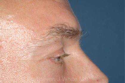 Eyelid Surgery - Blepharoplasty - Lower Eyelids Before & After Patient #5474