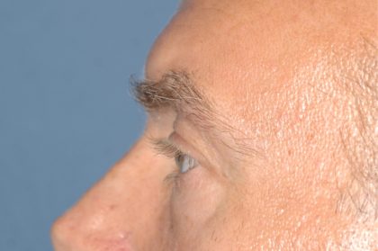 Eyelid Surgery - Blepharoplasty - Lower Eyelids Before & After Patient #5474