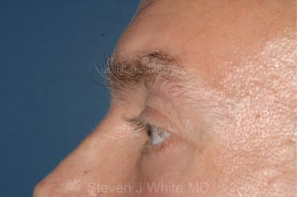 Eyelid Surgery - Blepharoplasty - Lower Eyelids Before & After Patient #5474