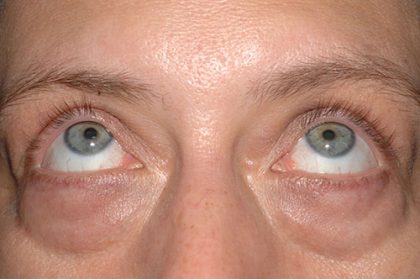 Eyelid Surgery - Blepharoplasty - Lower Eyelids Before & After Patient #5477