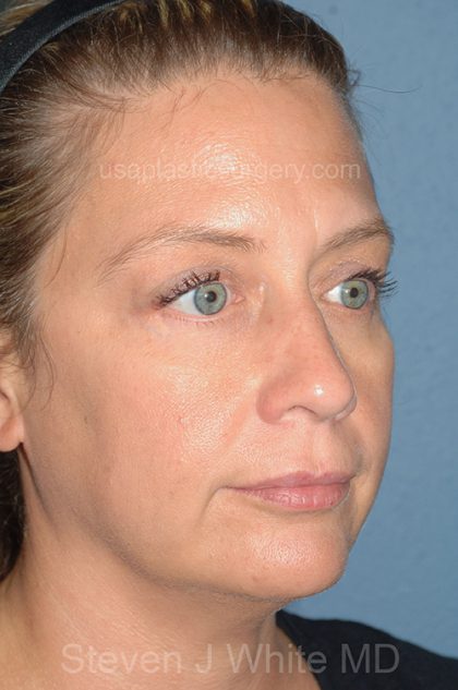 Eyelid Surgery - Blepharoplasty - Lower Eyelids Before & After Patient #5477