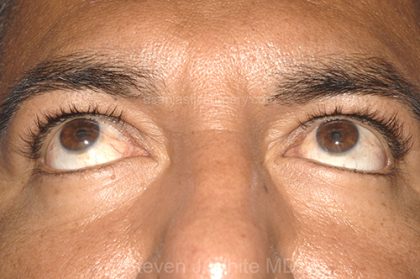 Eyelid Surgery - Blepharoplasty - Lower Eyelids Before & After Patient #5476