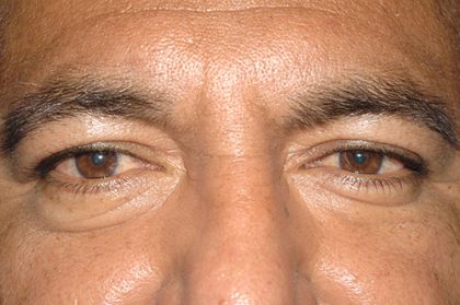 Eyelid Surgery - Blepharoplasty - Lower Eyelids Before & After Patient #5476
