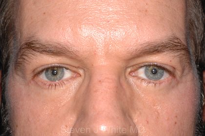 Eyelid Surgery - Blepharoplasty - Lower Eyelids Before & After Patient #5475