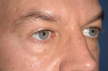Eyelid Surgery - Blepharoplasty - Lower Eyelids Before & After Patient #5475