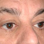 Eyelid Surgery - Blepharoplasty - Lower Eyelids Before & After Patient #5473