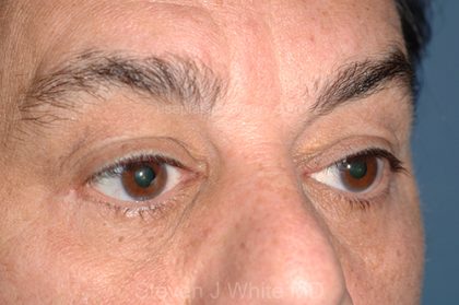 Eyelid Surgery - Blepharoplasty - Lower Eyelids Before & After Patient #5473