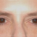 Eyelid Surgery - Blepharoplasty - Lower Eyelids Before & After Patient #5472