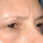 Eyelid Surgery - Blepharoplasty - Lower Eyelids Before & After Patient #5472