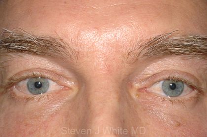 Eyelid Surgery - Blepharoplasty - Lower Eyelids Before & After Patient #5474