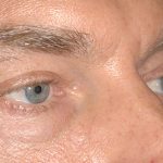 Eyelid Surgery - Blepharoplasty - Lower Eyelids Before & After Patient #5474