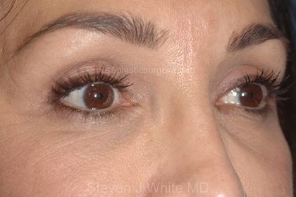 Eyelid Surgery - Blepharoplasty - Upper Eyelids Before & After Patient #5334