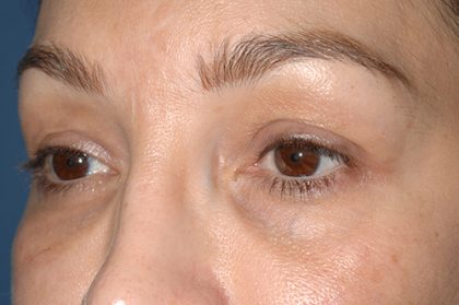 Eyelid Surgery - Blepharoplasty - Upper Eyelids Before & After Patient #5334