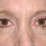 Eyelid Surgery - Blepharoplasty - Upper Eyelids Before & After Patient #5331