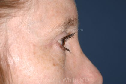 Eyelid Surgery - Blepharoplasty - Upper Eyelids Before & After Patient #5331