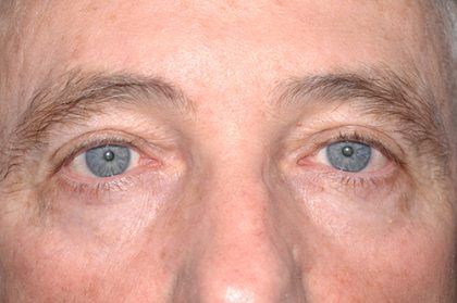 Eyelid Surgery - Blepharoplasty - Upper Eyelids Before & After Patient #5333