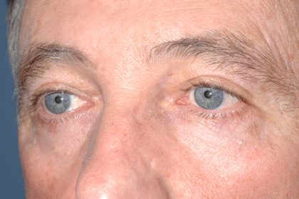 Eyelid Surgery - Blepharoplasty - Upper Eyelids Before & After Patient #5333