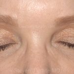 Eyelid Surgery - Blepharoplasty - Upper Eyelids Before & After Patient #5325