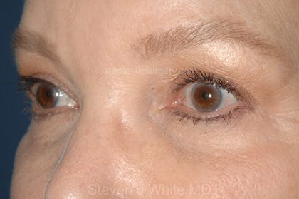 Eyelid Surgery - Blepharoplasty - Upper Eyelids Before & After Patient #5325