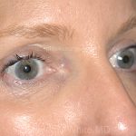 Eyelid Surgery - Blepharoplasty - Upper Eyelids Before & After Patient #5324