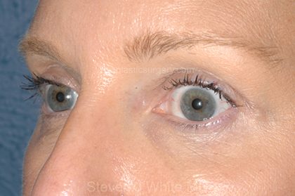 Eyelid Surgery - Blepharoplasty - Upper Eyelids Before & After Patient #5324