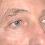 Eyelid Surgery - Blepharoplasty - Upper Eyelids Before & After Patient #5333