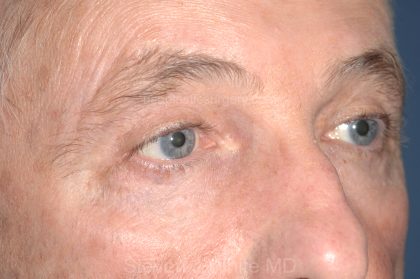 Eyelid Surgery - Blepharoplasty - Upper Eyelids Before & After Patient #5333