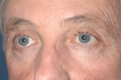 Eyelid Surgery - Blepharoplasty - Upper Eyelids Before & After Patient #5333
