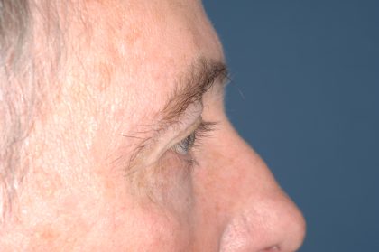 Eyelid Surgery - Blepharoplasty - Upper Eyelids Before & After Patient #5333