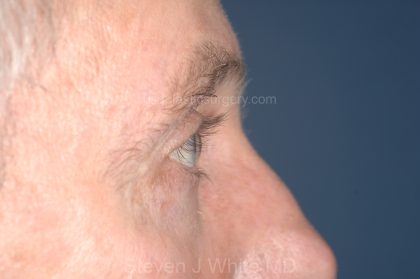 Eyelid Surgery - Blepharoplasty - Upper Eyelids Before & After Patient #5333