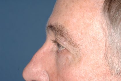 Eyelid Surgery - Blepharoplasty - Upper Eyelids Before & After Patient #5333