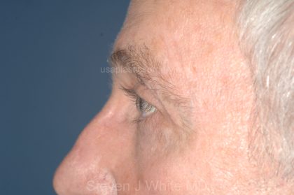 Eyelid Surgery - Blepharoplasty - Upper Eyelids Before & After Patient #5333