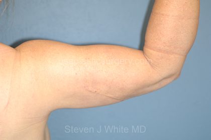 Liposuction - Arms Before & After Patient #5574