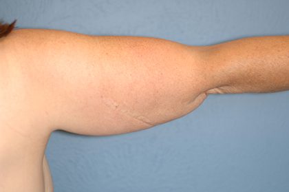 Liposuction - Arms Before & After Patient #5574
