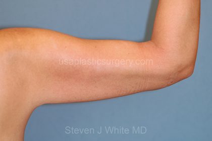 Liposuction - Arms Before & After Patient #5573