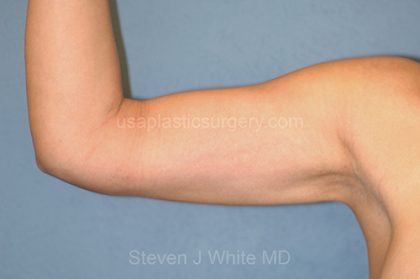 Liposuction - Arms Before & After Patient #5573