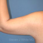 Liposuction - Arms Before & After Patient #5575
