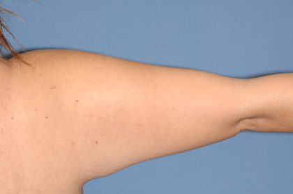 Liposuction - Arms Before & After Patient #5575