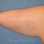 Liposuction - Arms Before & After Patient #5576